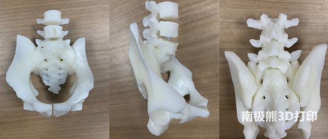 3D打印技術(shù)助力脊柱手術(shù)，讓患者重獲新生
