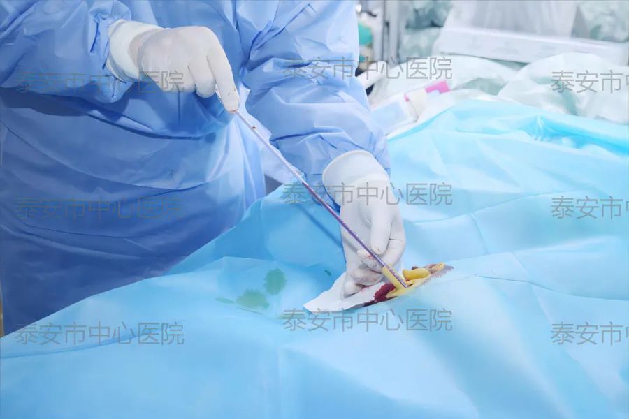 山東泰安3D打印技術為穿刺治療腦干出血患者再添新手段